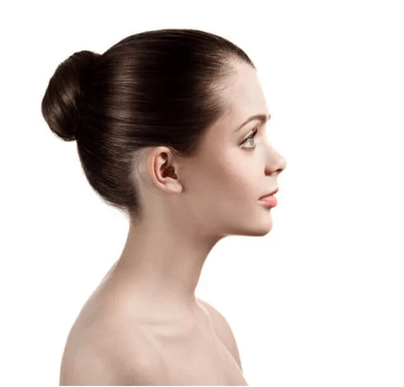 rhinoplasty