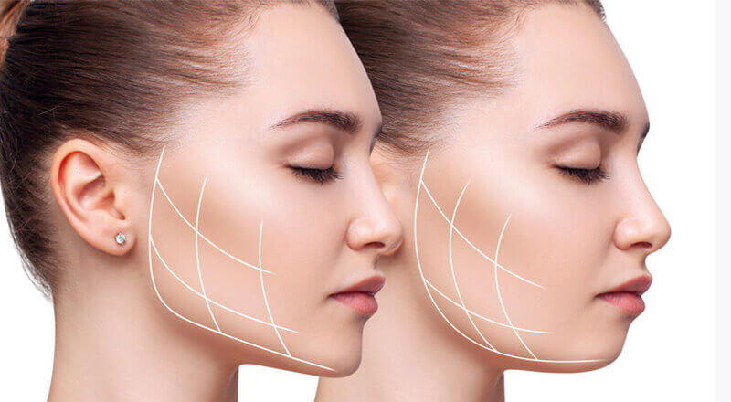 cheek reduction