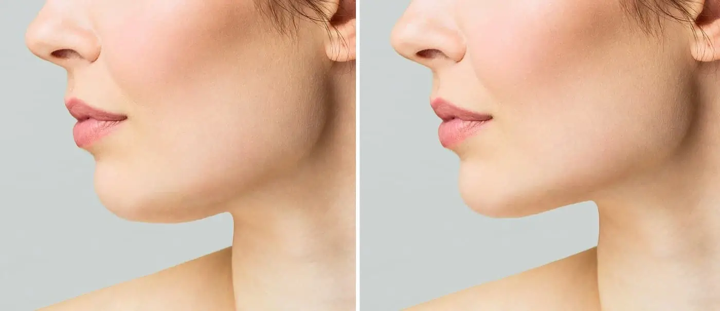 chin augmentation