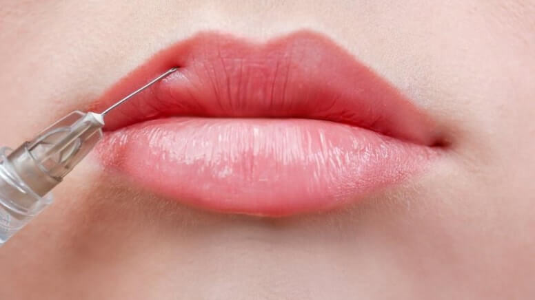 lip fillers