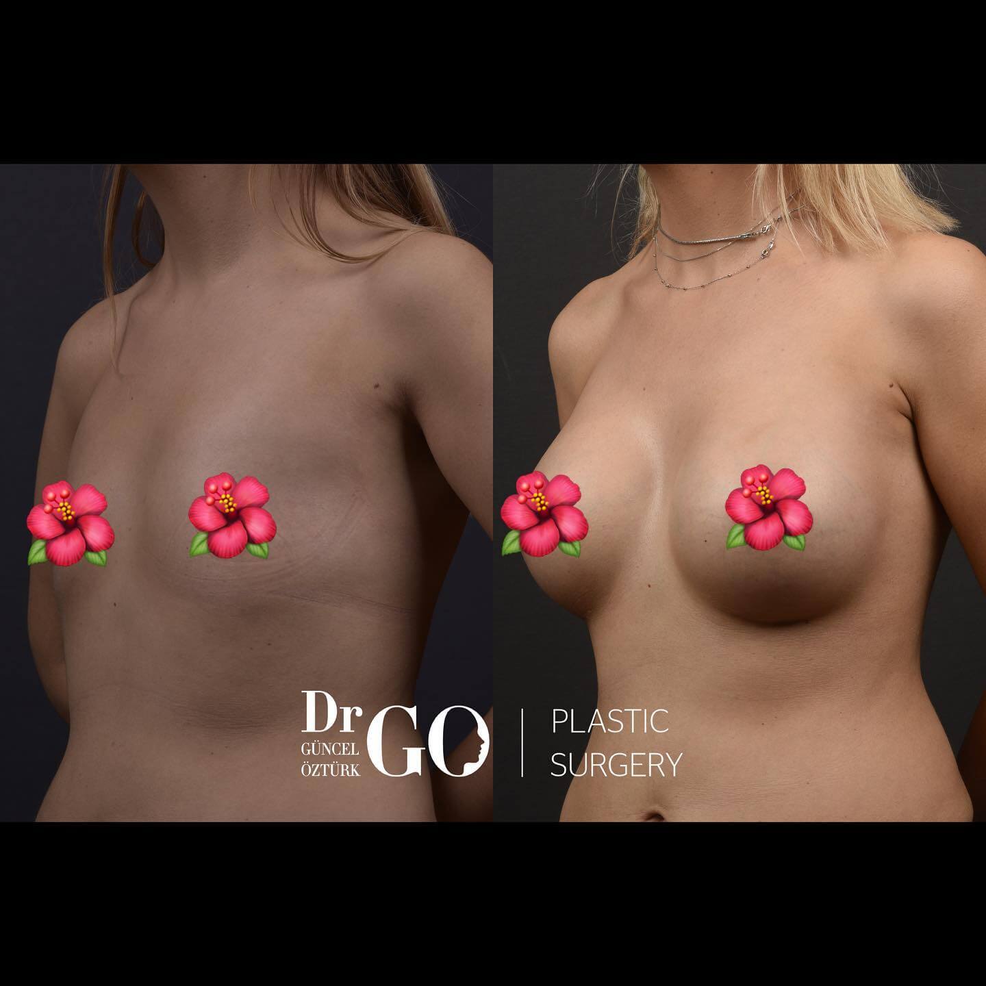 breast surgery