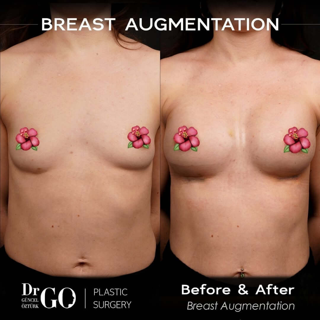 Breast Augmentation in Turkey